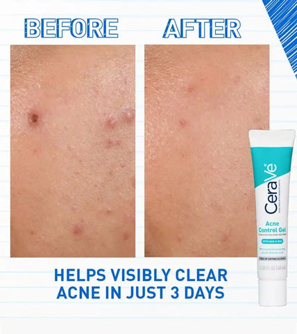 Acne Control Gel